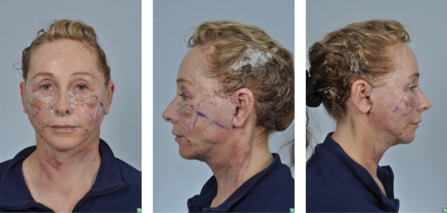 woman 1 day after face and neck lift procedure